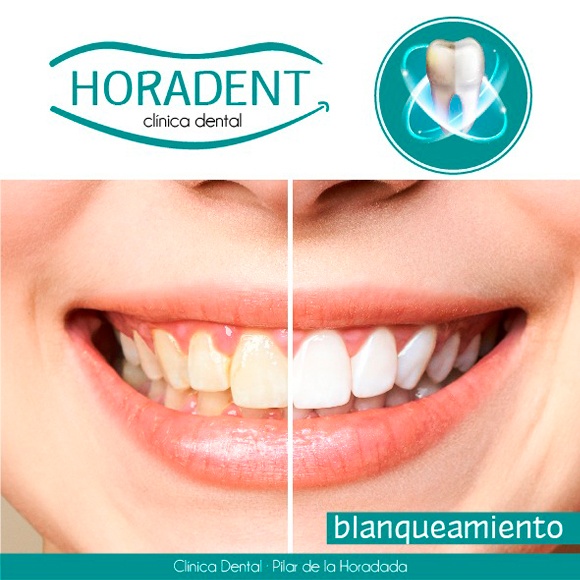 Blanqueamiento