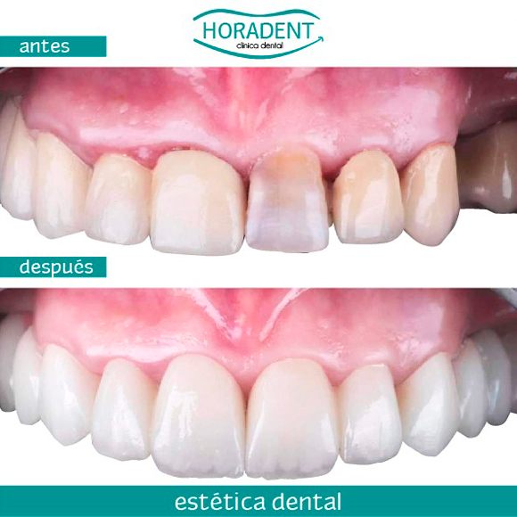 Estética Dental