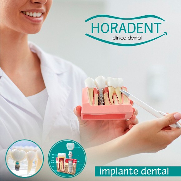 Implante Dental