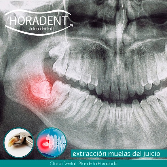 blog-muelas-juicio