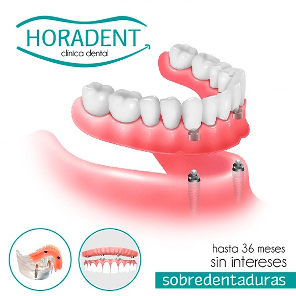 Sobredentaduras